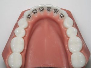 ارتودنسی پشت دندان