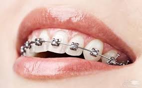 ارتودنسی دندان اقساطی-2
