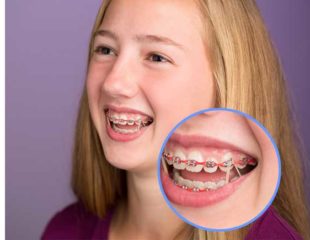 ارتودنسی دندان به روش خانگی-1