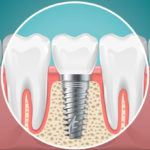 ارتودنسی دندان ایمپلنت شده-1