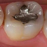 ارتودنسی دندان پر شده-1