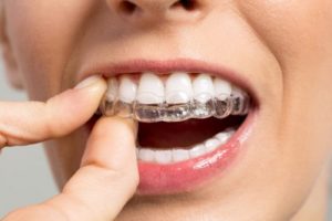 ارتودنسی دندان رایگان
