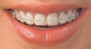 ارتودنسی دندان چند مرحله دارد