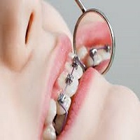 ارتودنسی فوری