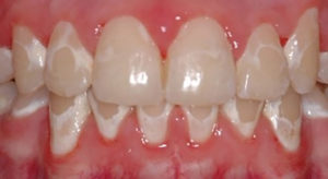 ارتودنسی دندان پوسیده-2