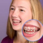 ارتودنسی دندان به روش خانگی-1