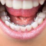 ارتودنسی دندان پایین-1