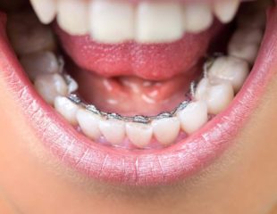 ارتودنسی دندان پایین-1