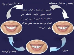 ارتودنسی دندان به روش خانگی-2