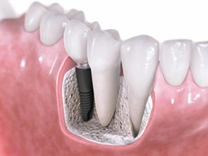 ارتودنسی دندان ایمپلنت شده-2