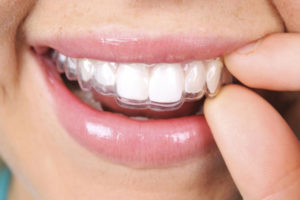  ارتودنسی دندان پر شده-2