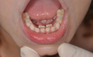 ارتودنسی دندان اضافه-2