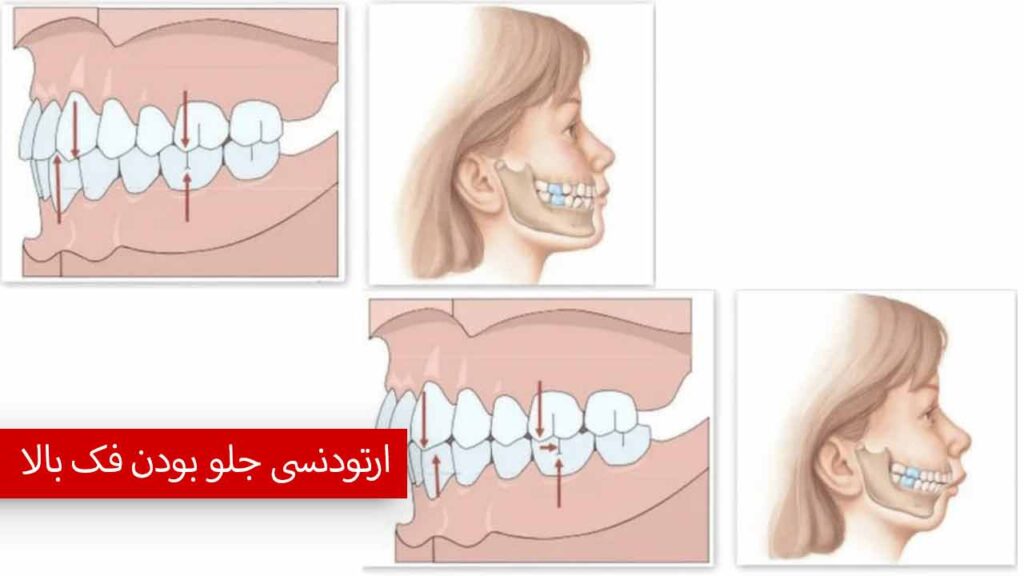 ارتودنسی جلو بودن فک بالا