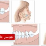 ارتودنسی جلو بودن فک بالا