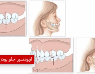 ارتودنسی جلو بودن فک بالا