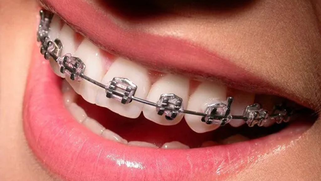 مزایای روش ارتودنسی دندان