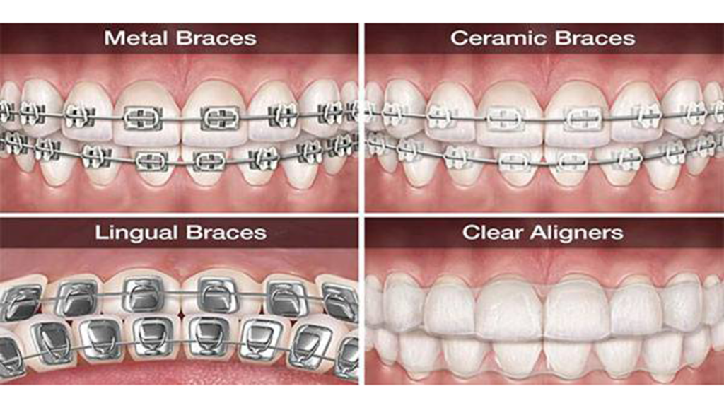 انواع ارتودنسی