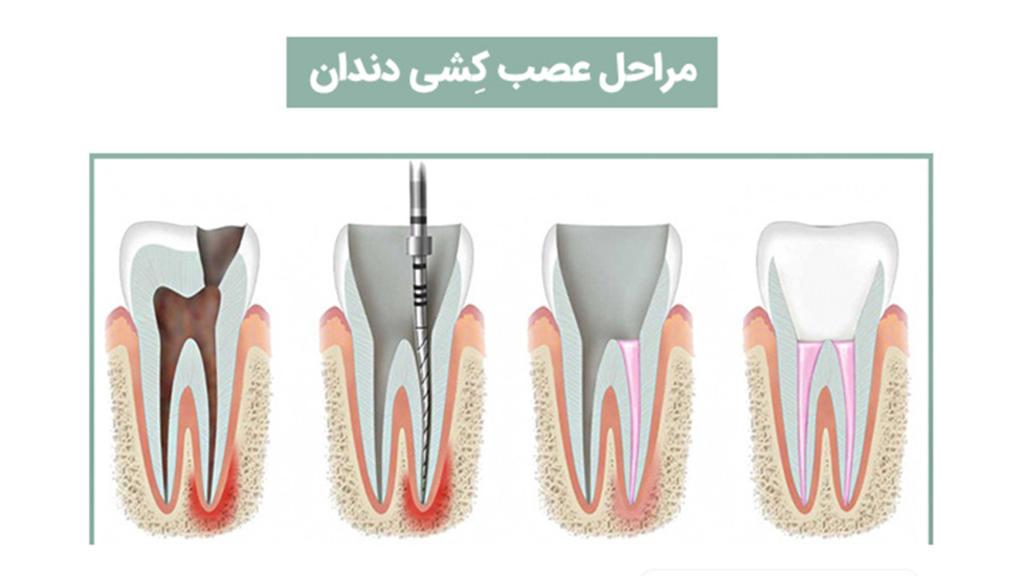 عصب کشی دندان‌