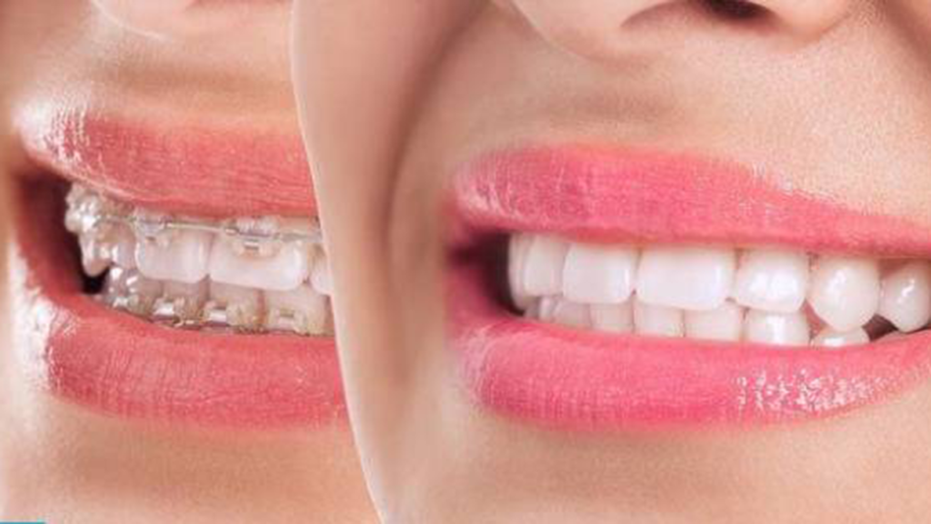ارتودنسی سریع دندان