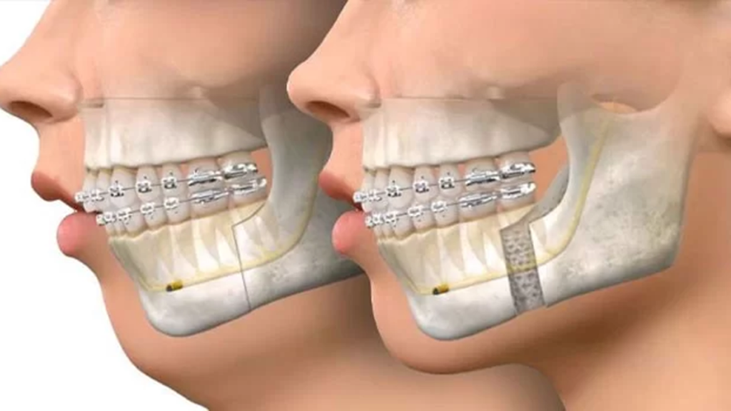 ارتودنسی قبل از جراحی فک