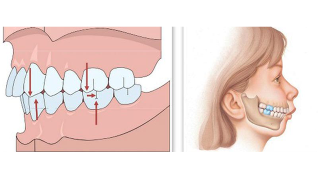 اوربایت دندان چیست و چگونه درمان میشود؟