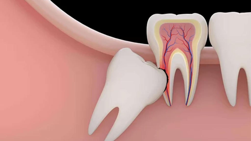 وجود دندان اضافی بعد از درمان