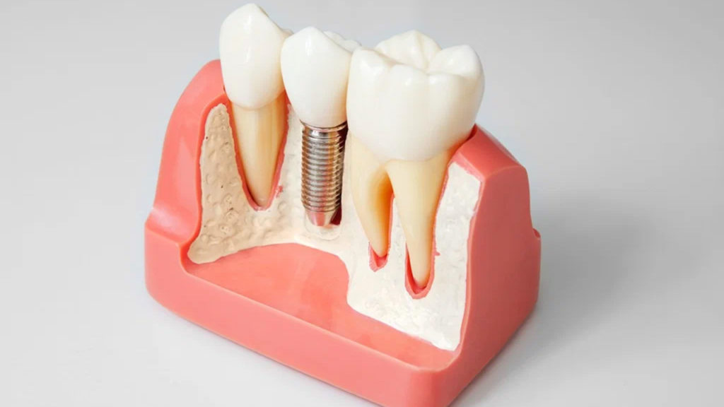 عوامل موثر در هزینه ایمپلنت دندان            