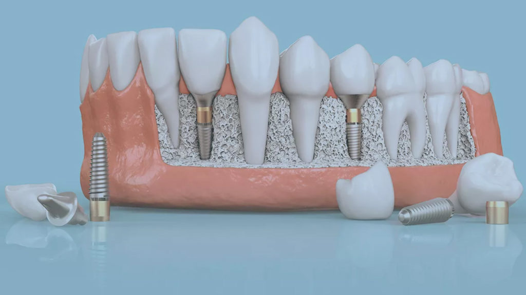 مزایای ایمپلنت دندان