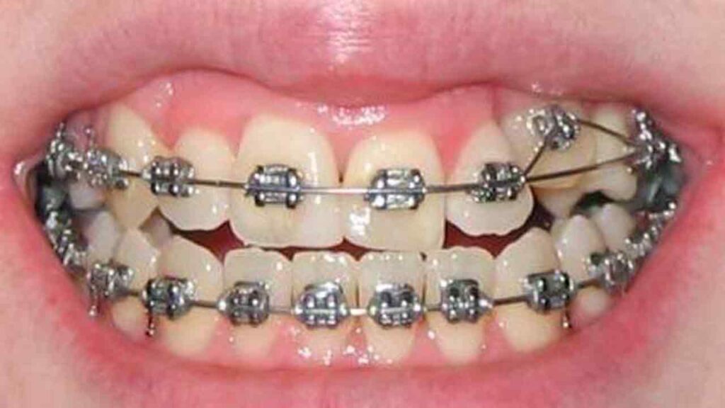 علل رشد دندان اضافه‌