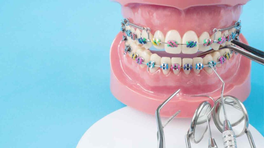 راهکارهای بهبود عوارض و مشکلات ارتودنسی دندان
