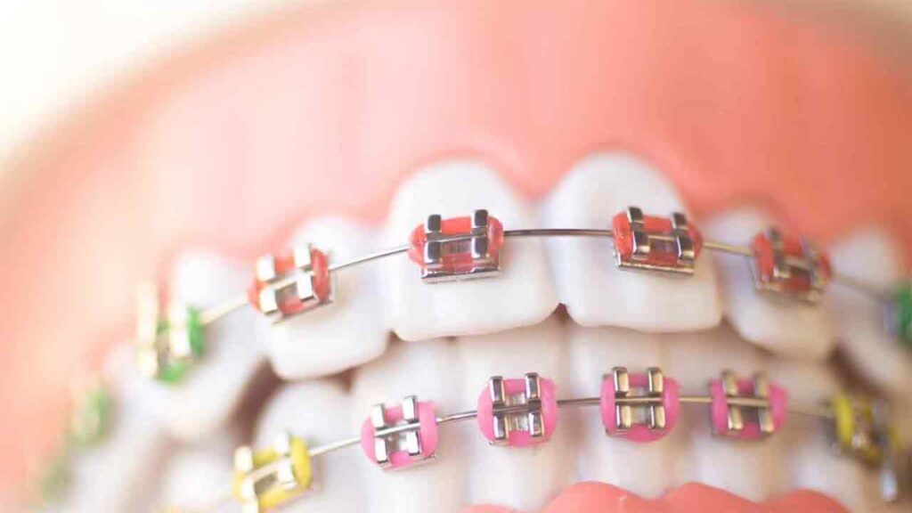 عوارض ارتودنسی دندان چیست؟